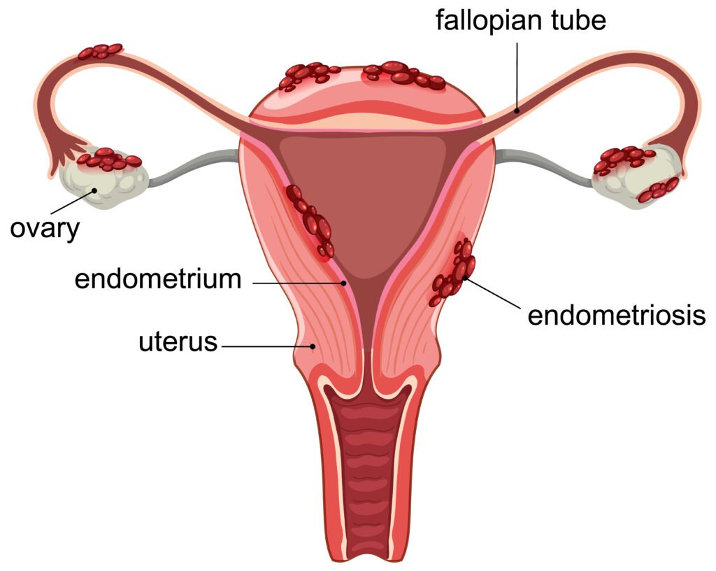 visual illustration of endometriosis
